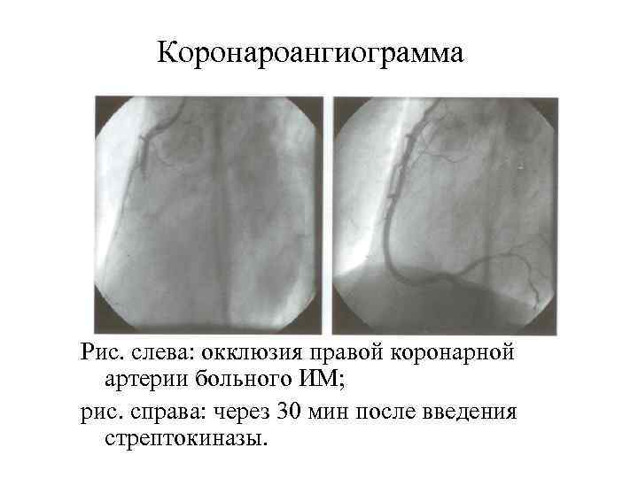   Коронароангиограмма Рис. слева: окклюзия правой коронарной  артерии больного ИМ;  рис.