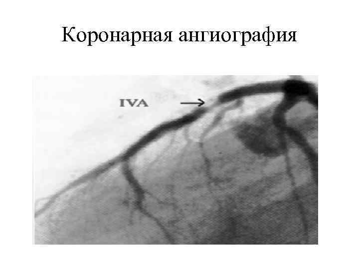 Коронарная ангиография 