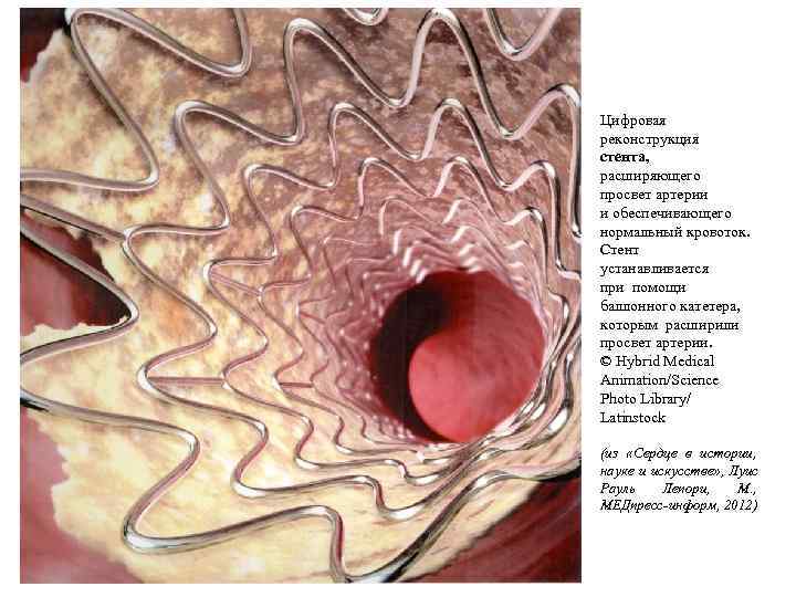 Цифровая реконструкция стента, расширяющего просвет артерии и обеспечивающего нормальный кровоток.  Стент устанавливается при