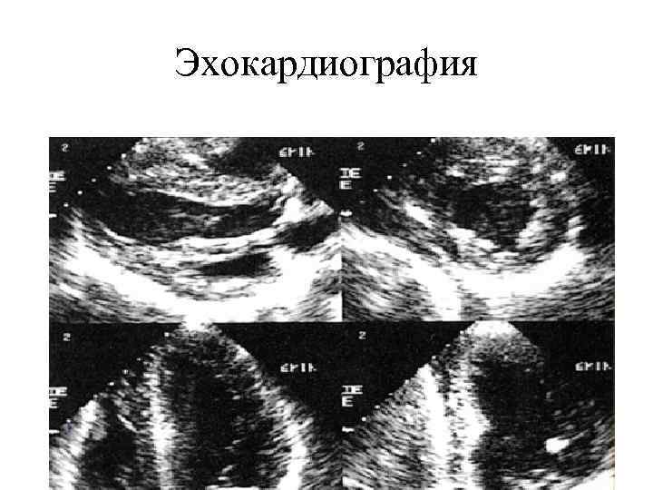 Эхокардиография 