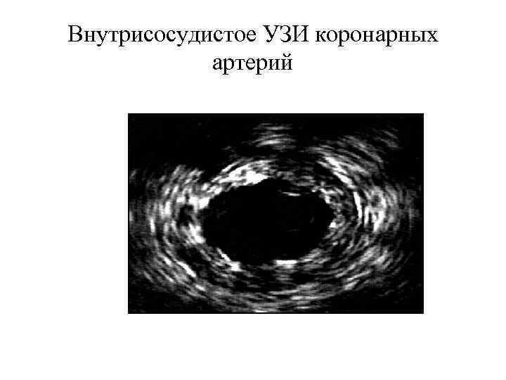 Внутрисосудистое УЗИ коронарных   артерий 