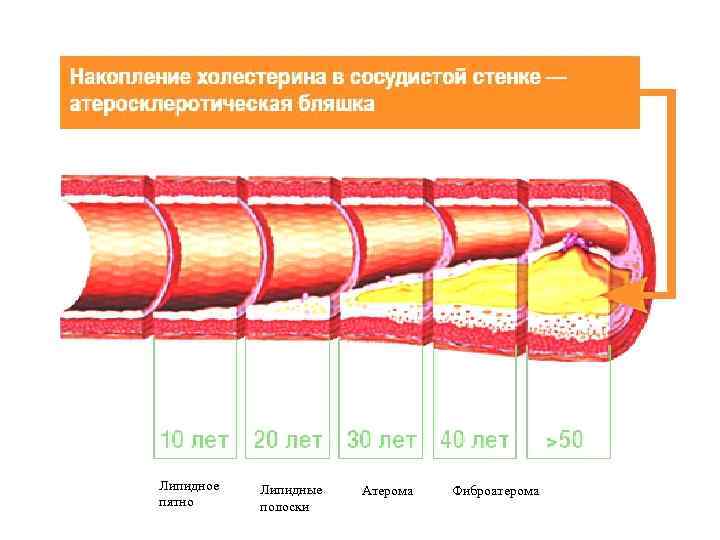 Липидное  Липидные  Атерома  Фиброатерома пятно  полоски 