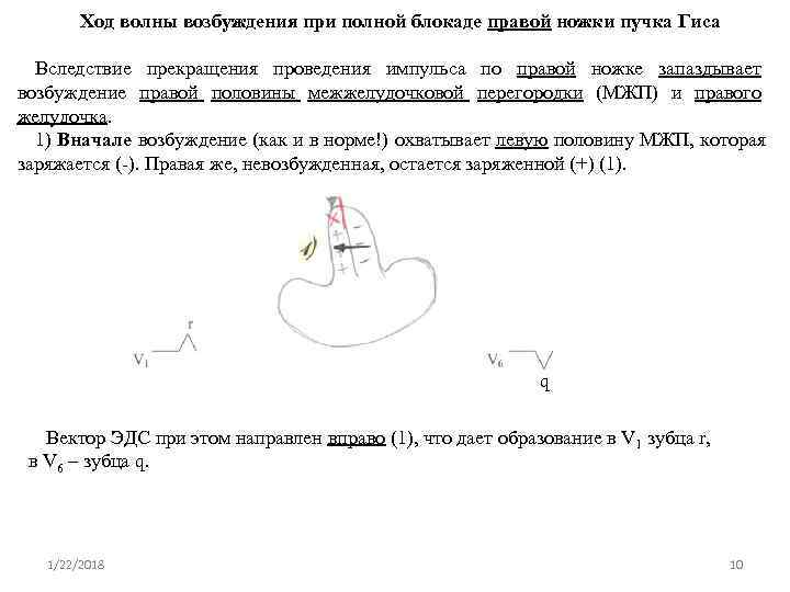   Ход волны возбуждения при полной блокаде правой ножки пучка Гиса  Вследствие