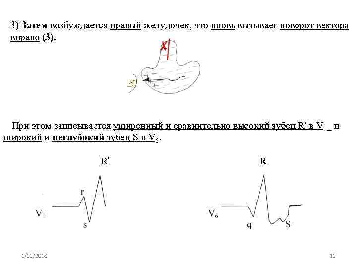 3) Затем возбуждается правый желудочек, что вновь вызывает поворот вектора вправо (3). 