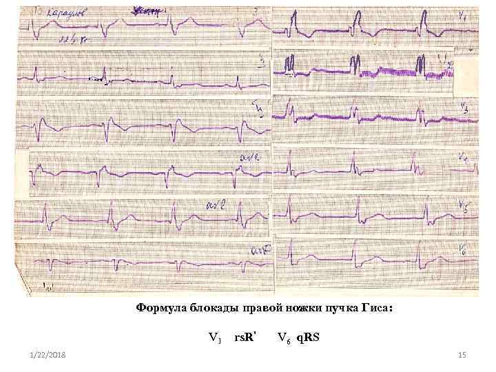    Полная блокада правой ножки пучка Гиса   Формула блокады правой