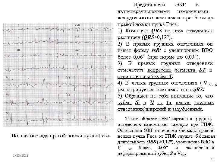     Представлена  ЭКГ  с    вышеперечисленными изменениями