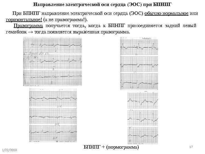    Направление электрической оси сердца (ЭОС) при БПНПГ  При БПНПГ направление