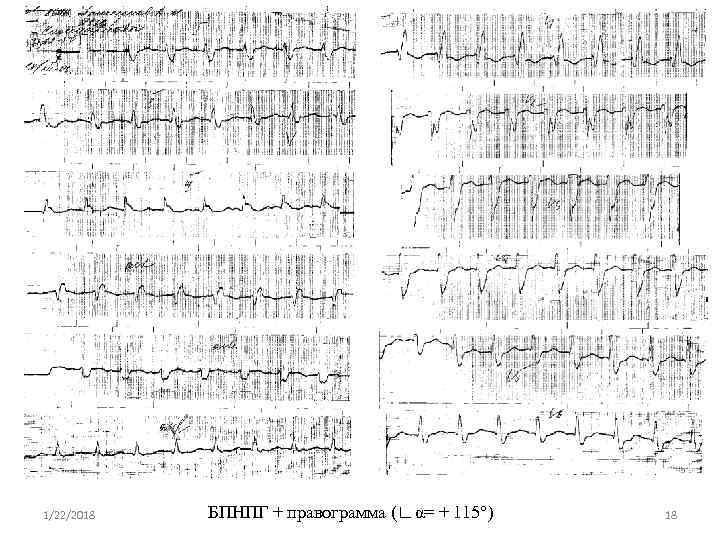 1/22/2018  БПНПГ + правограмма (∟α= + 115°)  18 