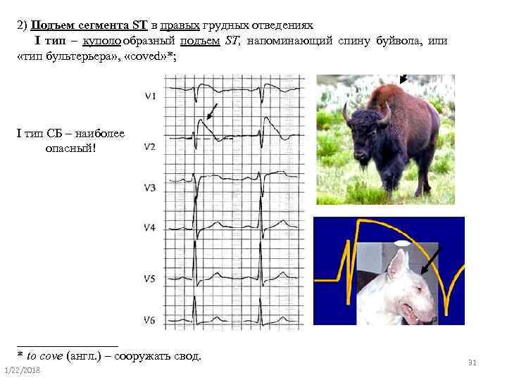   2) Подъем сегмента ST в правых грудных отведениях   I тип