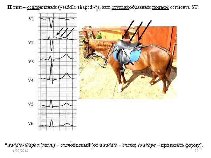  II тип – седловидный ( «saddle-shaped» *), или ступенеобразный подъем сегмента ST. _____________