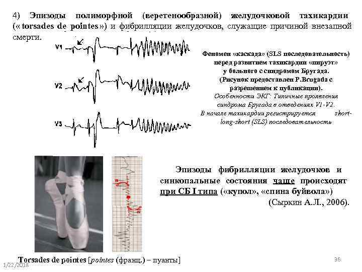   4) Эпизоды полиморфной (веретенообразной) желудочковой тахикардии  ( « torsades de pointes