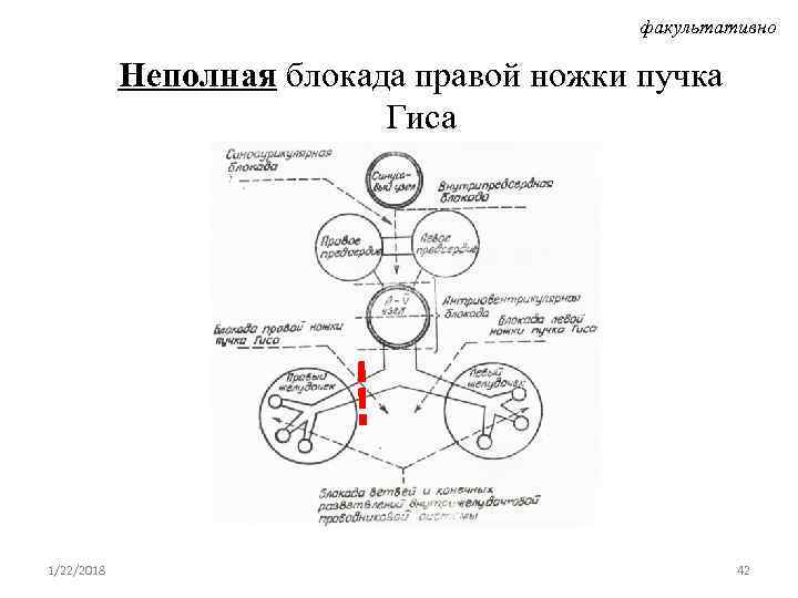        факультативно   Неполная блокада правой ножки