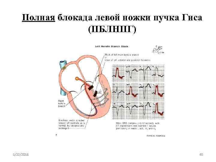  Полная блокада левой ножки пучка Гиса    (ПБЛНПГ) 1/22/2018  