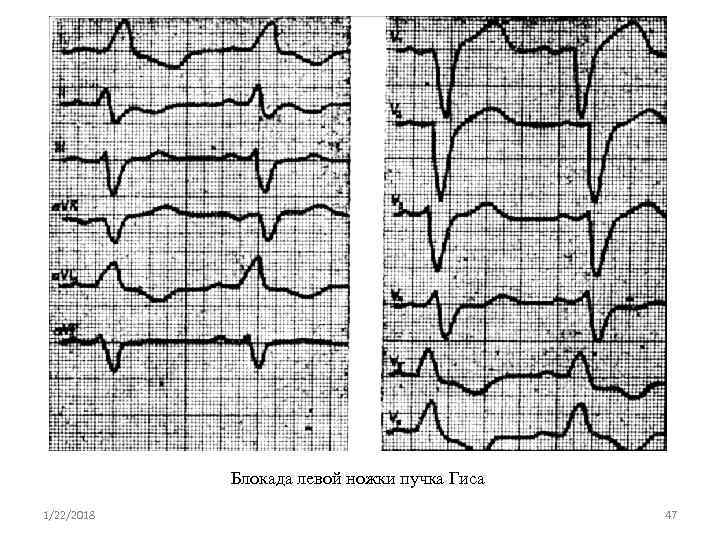   Блокада левой ножки пучка Гиса 1/22/2018      47