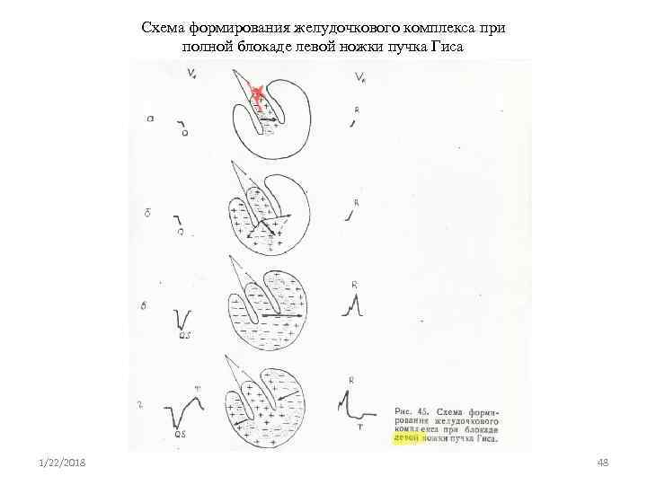   Схема формирования желудочкового комплекса при    полной блокаде левой ножки