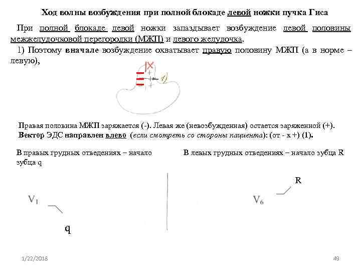    Ход волны возбуждения при полной блокаде левой ножки пучка Гиса При