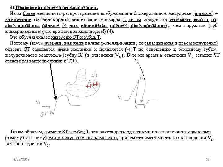  4) Изменение процесса реполяризации.  Из-за более медленного распространения возбуждения в блокированном желудочке