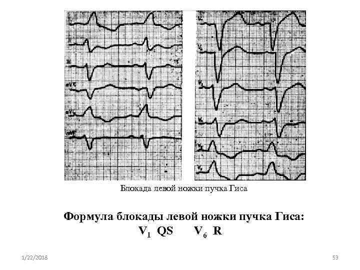      Блокада левой ножки пучка Гиса    Формула