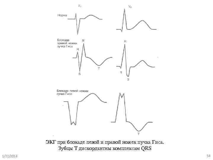   ЭКГ при блокаде левой и правой ножек пучка Гиса.   
