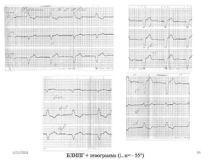 1/22/2018      56   БЛНПГ + левограмма (∟α= -