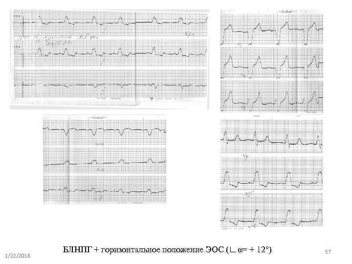   БЛНПГ + горизонтальное положение ЭОС (∟α= + 12°)  57 1/22/2018 