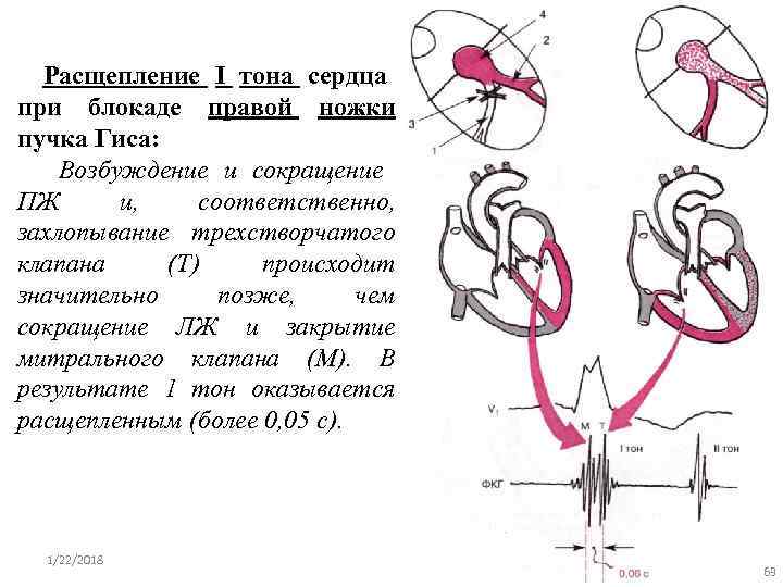  Расщепление I тона сердца  при блокаде правой ножки пучка Гиса: Возбуждение и