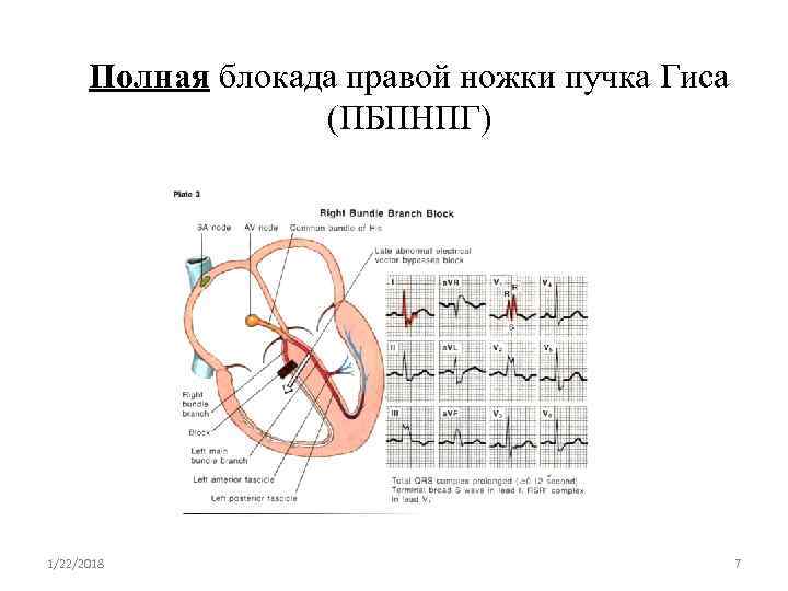 Полная блокада правой ножки пучка