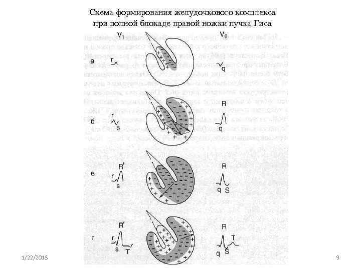   Схема формирования желудочкового комплекса    при полной блокаде правой ножки
