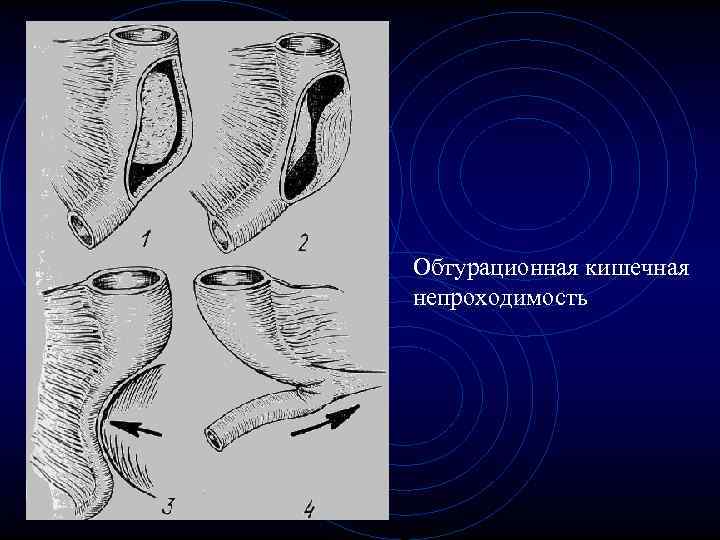 Обтурационная кишечная непроходимость Обтурационная кишечная непроходимость