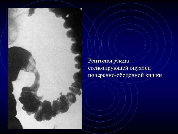 Рентгенограмма стенозирующей опухоли поперечно-ободочной кишки Рентгенограмма стенозирующей опухоли поперечно-ободочной кишки