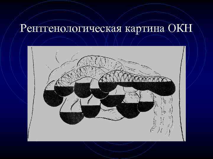 Рентгенологическая картина ОКН Рентгенологическая картина ОКН