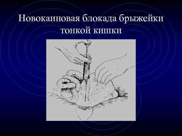 Новокаиновая блокада брыжейки тонкой кишки Новокаиновая блокада брыжейки тонкой кишки