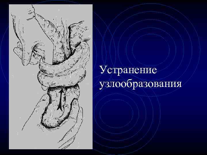 Устранение узлообразования Устранение узлообразования