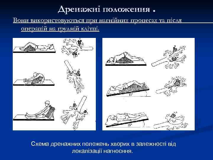    Дренажні положення. Вони використовуються при нагнійних процесах та після  операцій