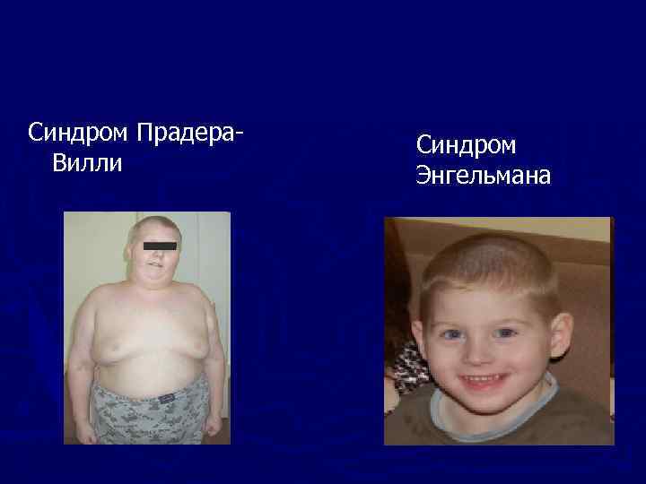 Синдром Прадера-  Синдром  Вилли  Энгельмана 
