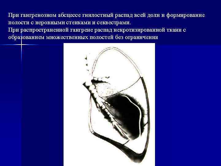 При гангренозном абсцессе гнилостный распад всей доли и формирование полости с неровными стенками и