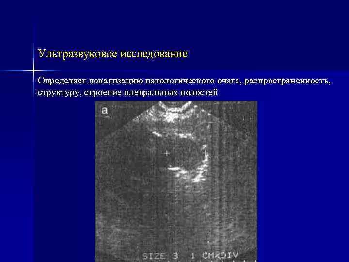 Ультразвуковое исследование Определяет локализацию патологического очага, распространенность, структуру, строение плевральных полостей 