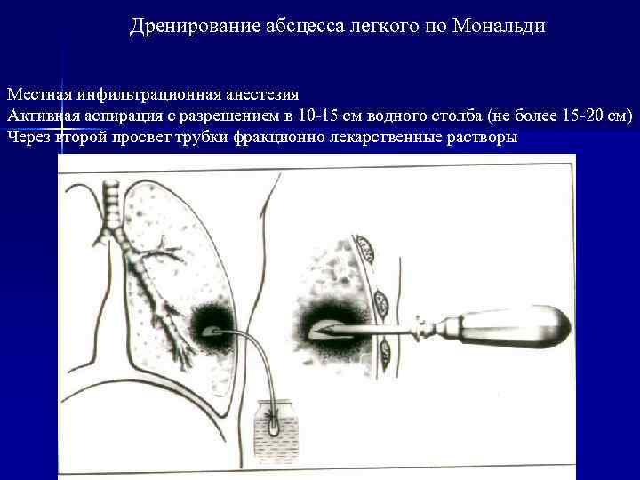 Гнойные заболевания легких картинки