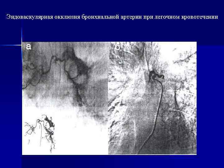 Гнойные заболевания легких презентация