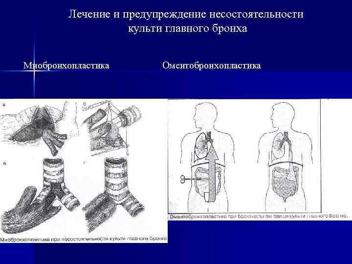   Лечение и предупреждение несостоятельности    культи главного бронха  Миобронхопластика