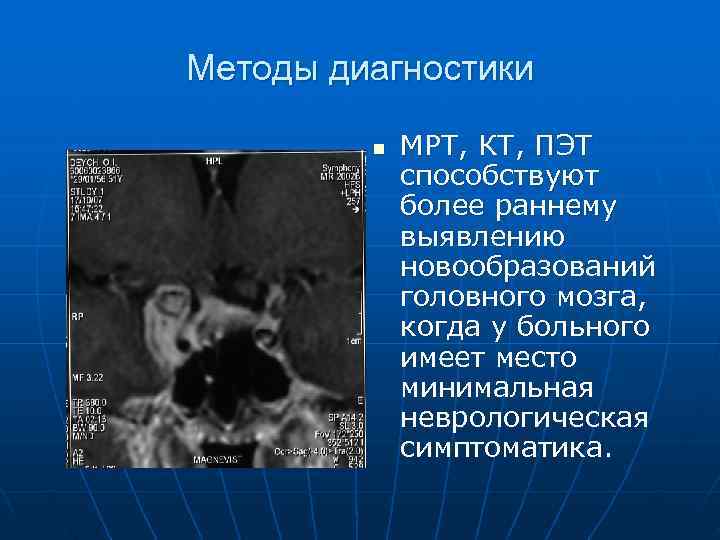 Методы диагностики  n  МРТ, КТ, ПЭТ   способствуют   более