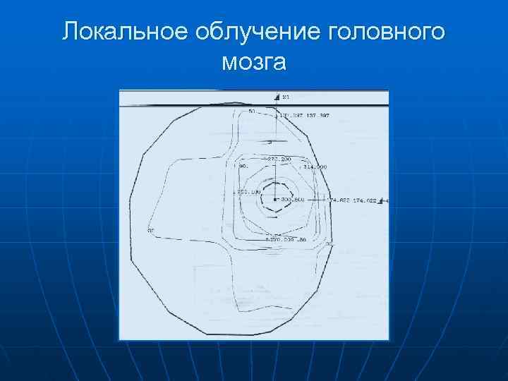 Локальное облучение головного   мозга 