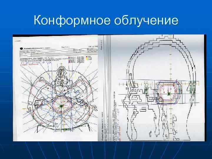Конформное облучение 