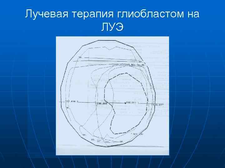 Лучевая терапия глиобластом на   ЛУЭ 