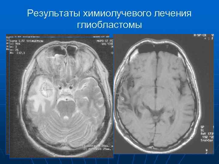 Результаты химиолучевого лечения  глиобластомы 