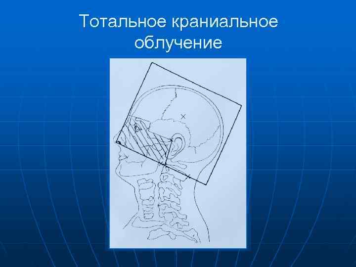 Тотальное краниальное  облучение 