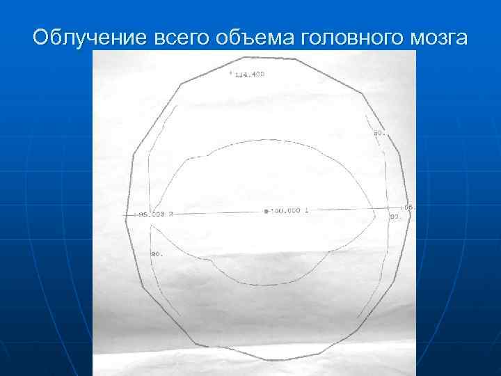 Облучение всего объема головного мозга 