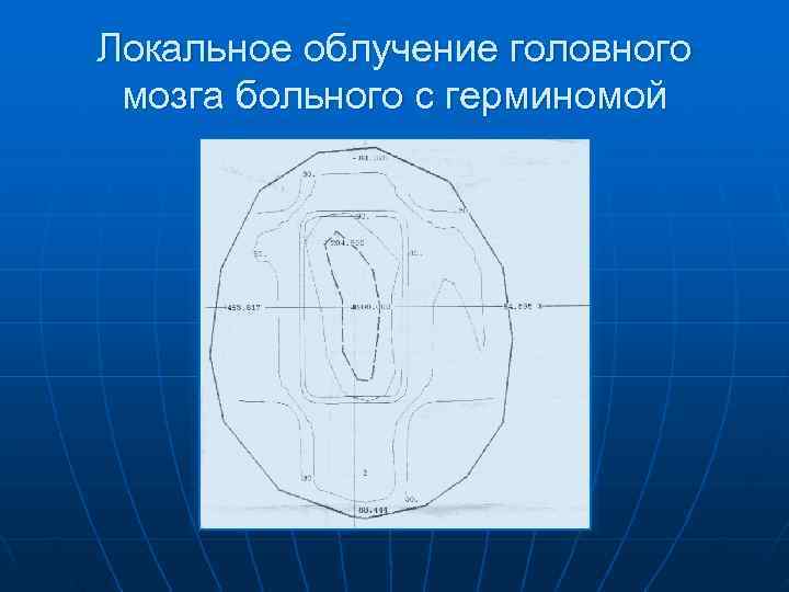 Локальное облучение головного мозга больного с герминомой 