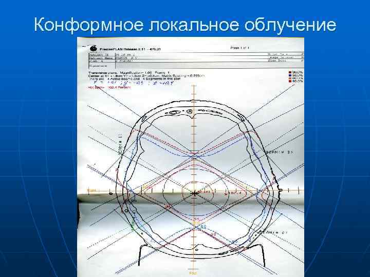 Конформное локальное облучение 