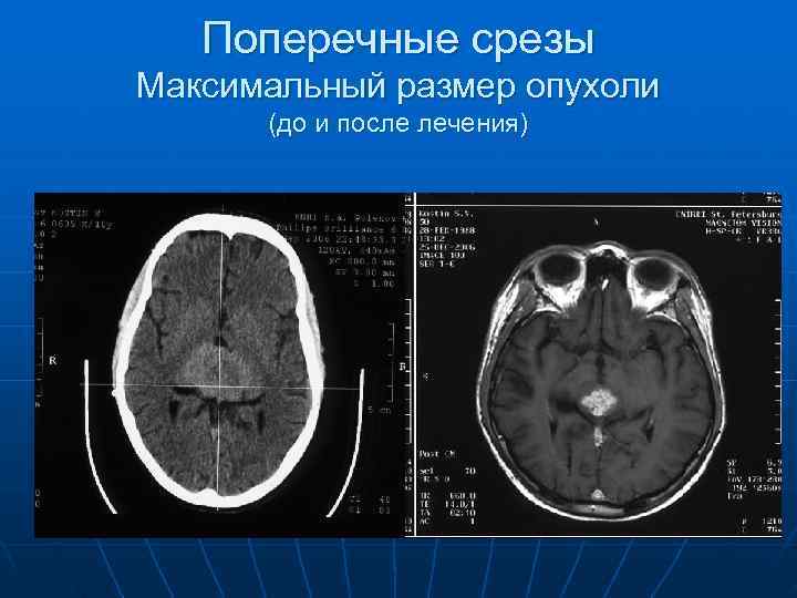   Поперечные срезы Максимальный размер опухоли  (до и после лечения) 